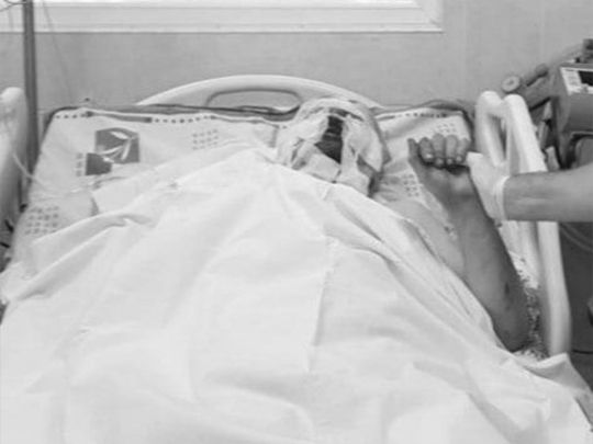 «Побачивши себе в дзеркалі, по-чоловічому гірко заплакав»: лікарям вдалося врятувати донеччанина, який сильно постраждав від обстрілу окупантів