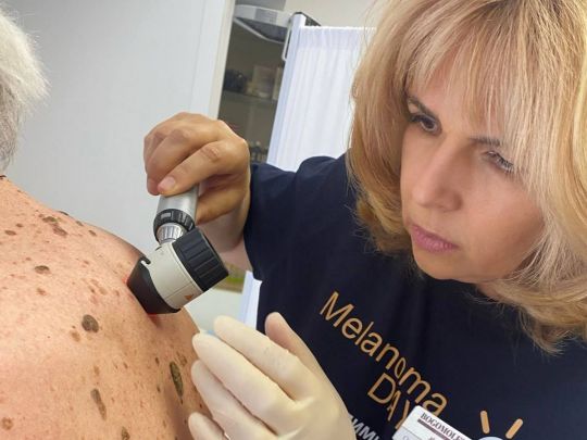 «А якщо це меланома? Підозрілу родимку треба терміново показати лікарю, щоб запобігти метастазам і врятувати життя», — Ольга Богомолець