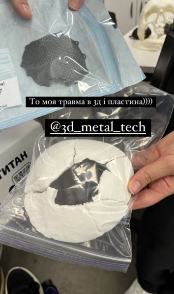 «Два тижні у комі»: Віктору Розовому поставили титанову пластину